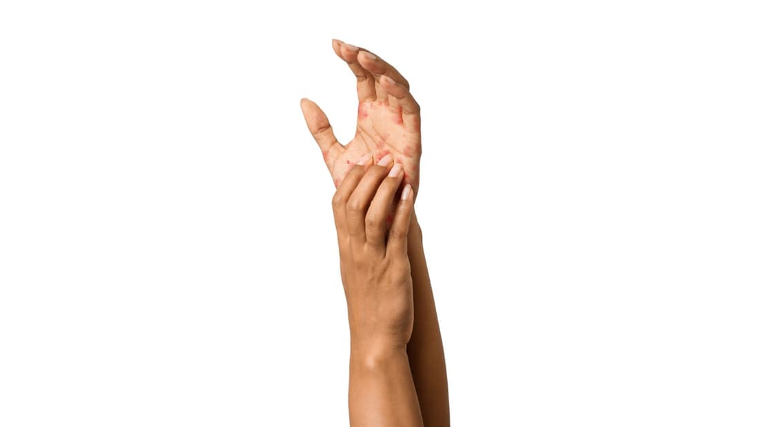 Hand showing a skin condition across diverse skin tones