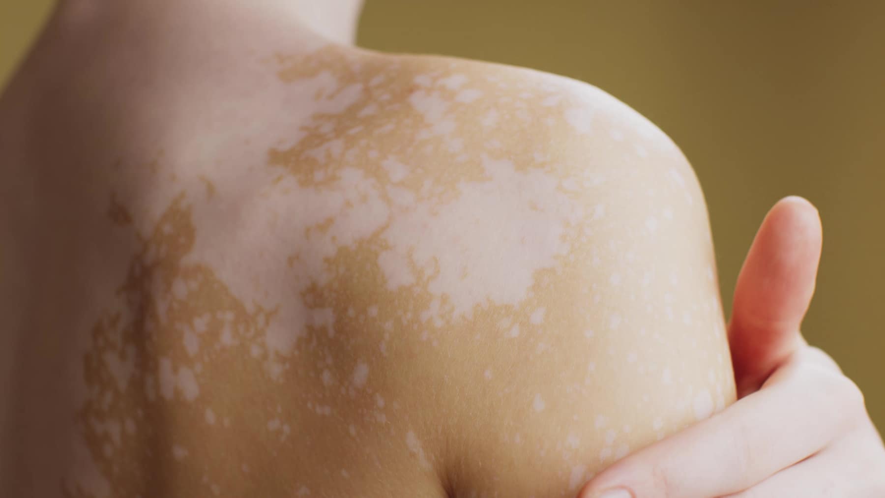 Close-up of skin showing vitiligo